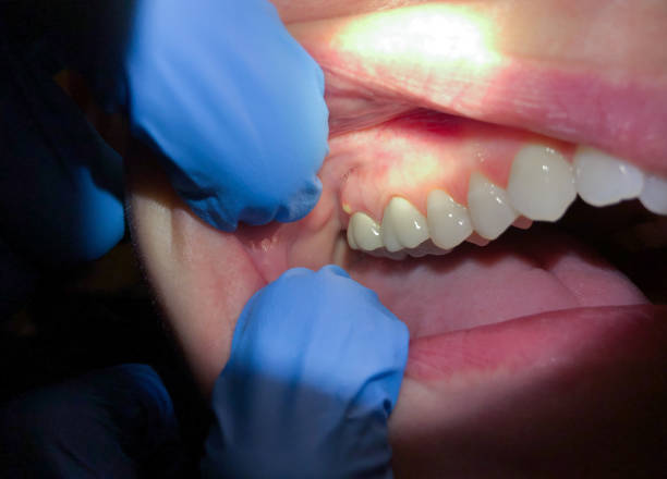 Best Dental Abscess Treatment in Central Heights Midland City, AZ